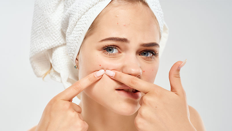 adult-onset-acne