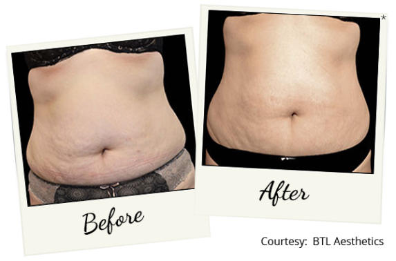 exilis-ba-1