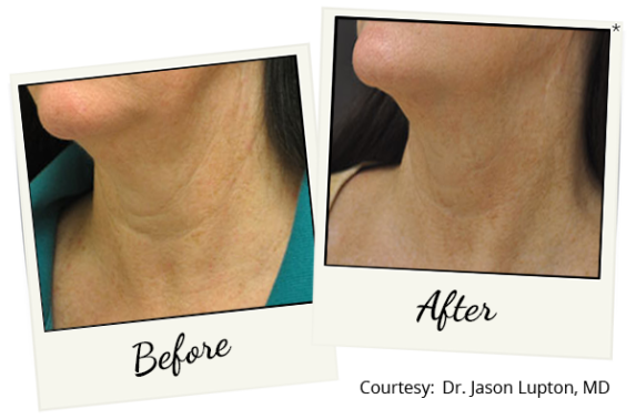 exilis-ba-10