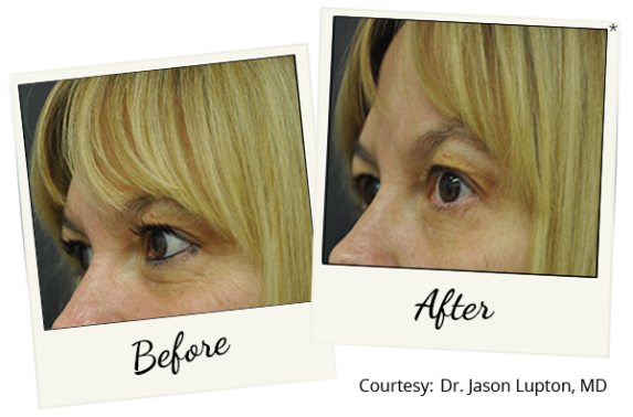 exilis-ba-12