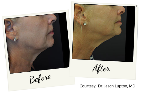 exilis-ba-16
