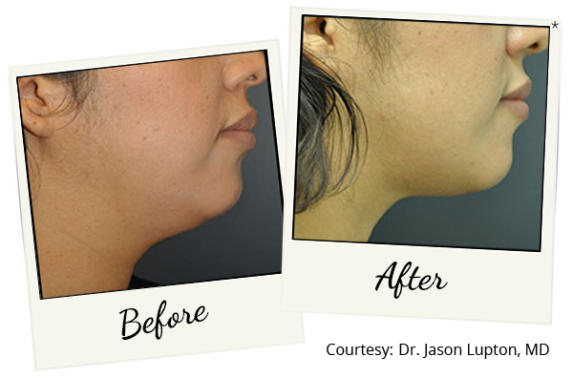 exilis-ba-18