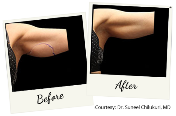 exilis-ba-5