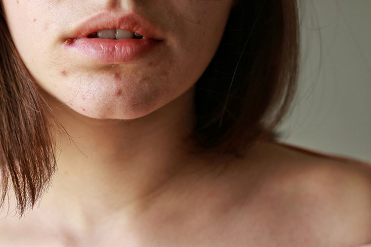 Hyperpigmentation on a woman's chin | Marin Medical Aesthetics