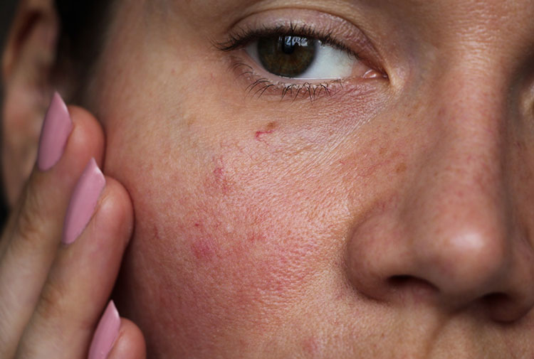 Woman with uneven Skin Texture | Marin Medical Aesthetics