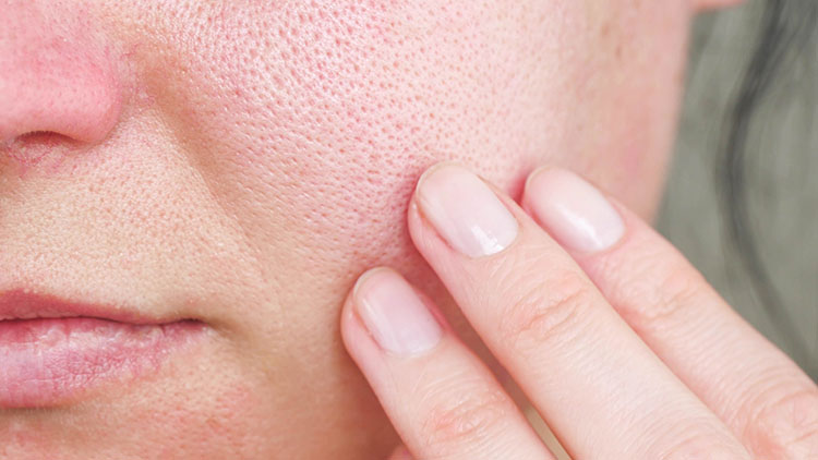 enlarged pores can be cured with skincare | Marin Medical Aesthetics San Rafael