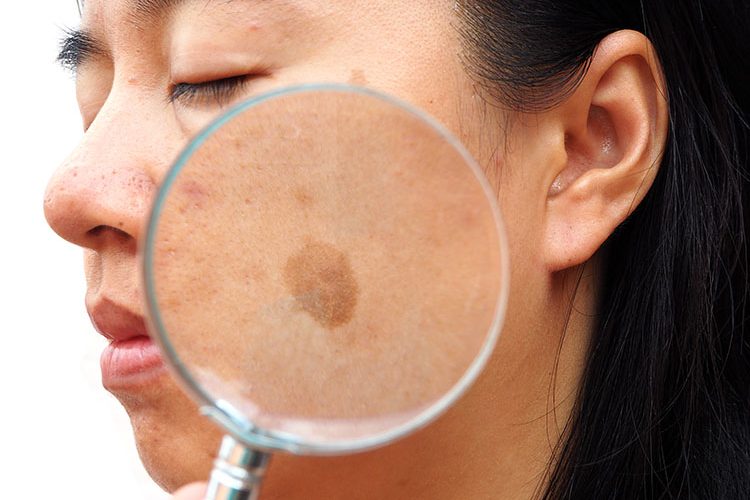 All about melasma | Marin Medical Aesthetics San Rafael