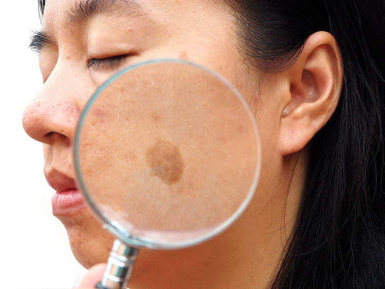 All about melasma | Marin Medical Aesthetics San Rafael