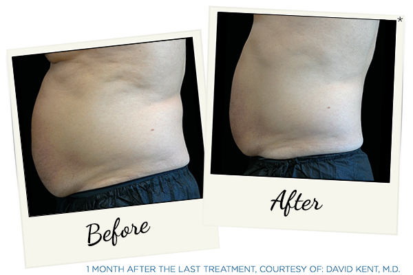 Emsculpt Neo Abdominal Body Contouring Treatment Emsculpt Neo abdominal body contouring information at Marin Medical Aesthetics