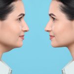 How to Get Rid of Double Chin San Anselmo