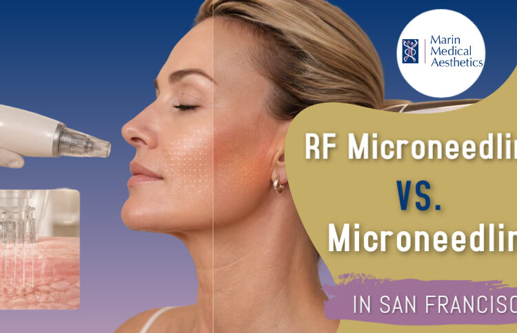 RF Microneedling vs. Microneedling in San Francisco