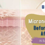 Microneedling Before And After In The Bay Area