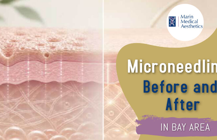 Microneedling Before And After In The Bay Area