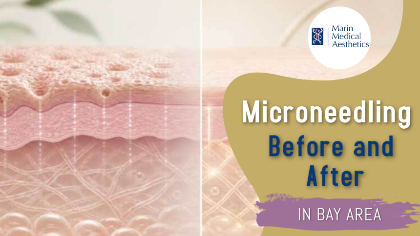 Microneedling Before And After In The Bay Area