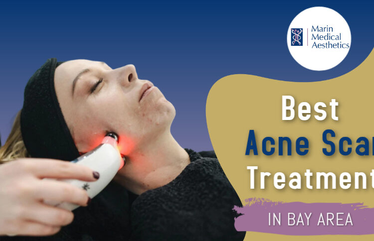Best Acne Scar Treatments Bay Area