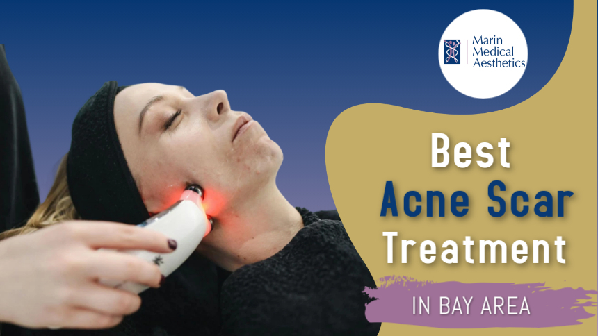 Best Acne Scar Treatments Bay Area