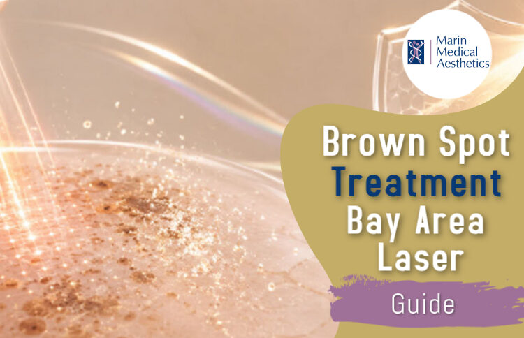 Brown Spot Treatment Bay Area Laser Guide