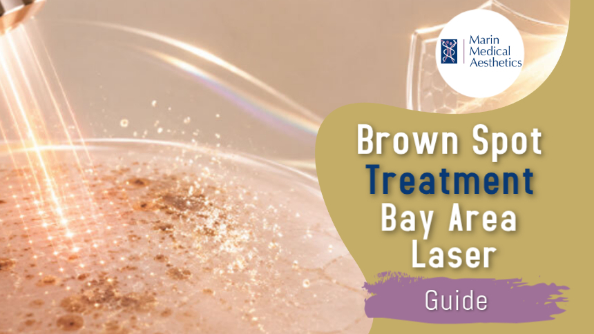 Brown Spot Treatment Bay Area Laser Guide