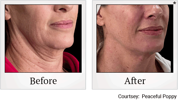 skin-tightening-treatment-before-after-1