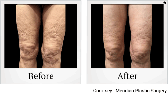 skin-tightening-treatment-before-after-2