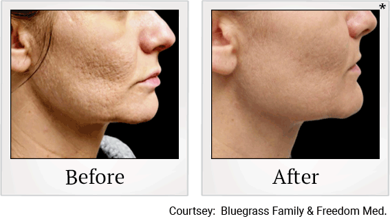 skin-tightening-treatment-before-after-4