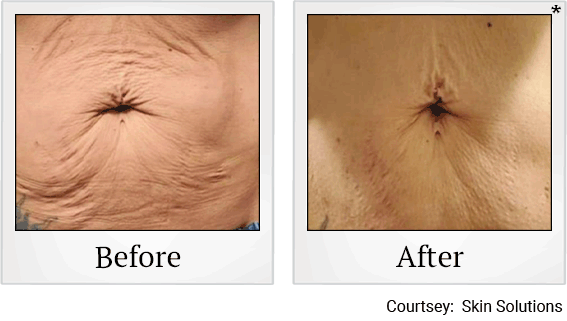 skin-tightening-treatment-before-after-5