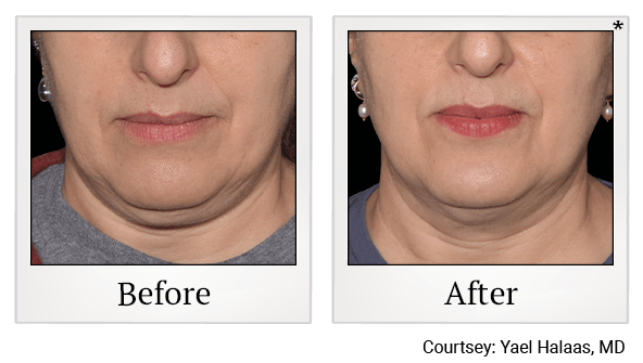 skin-tightening-treatment-before-after-6