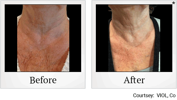 skin-tightening-treatment-before-after-7